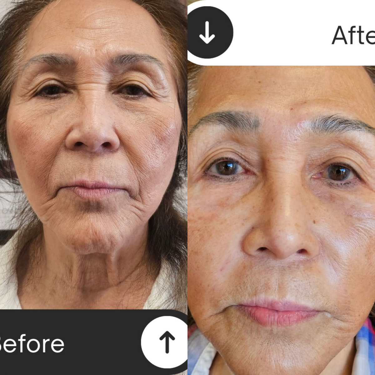 Before and after comparison showing chin and neck tightening results after one non-surgical treatment